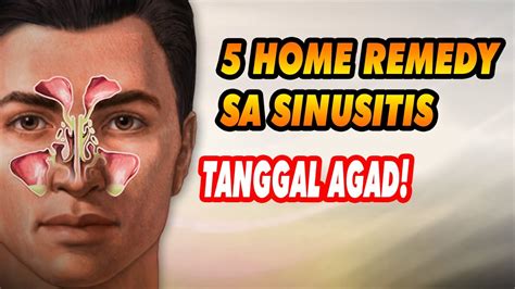 home remedy sa baradong inidoro|Sinusitis 101: Mga Sanhi at Solusyon Para Dito .